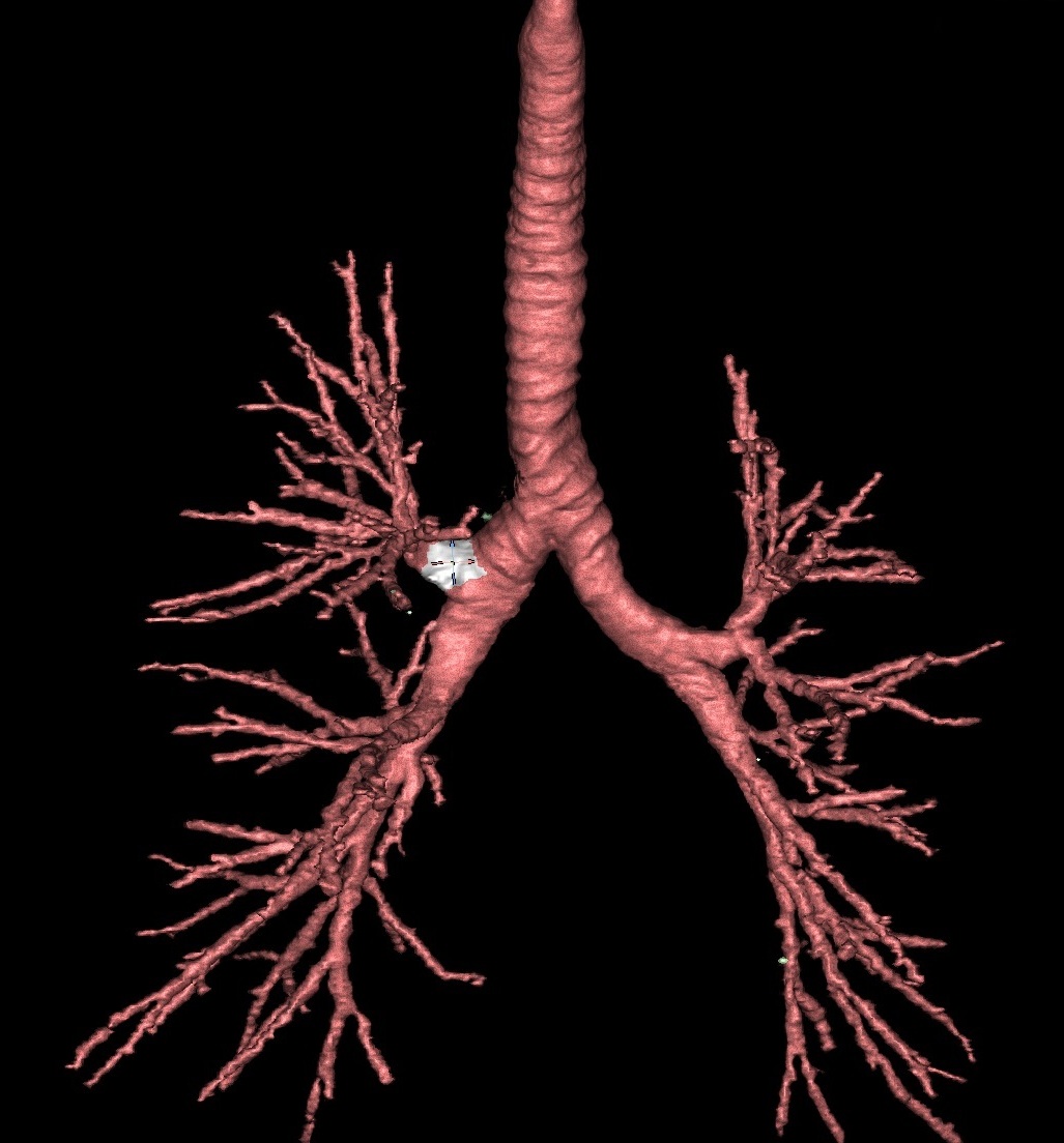 Airway Branches 3D Imaging