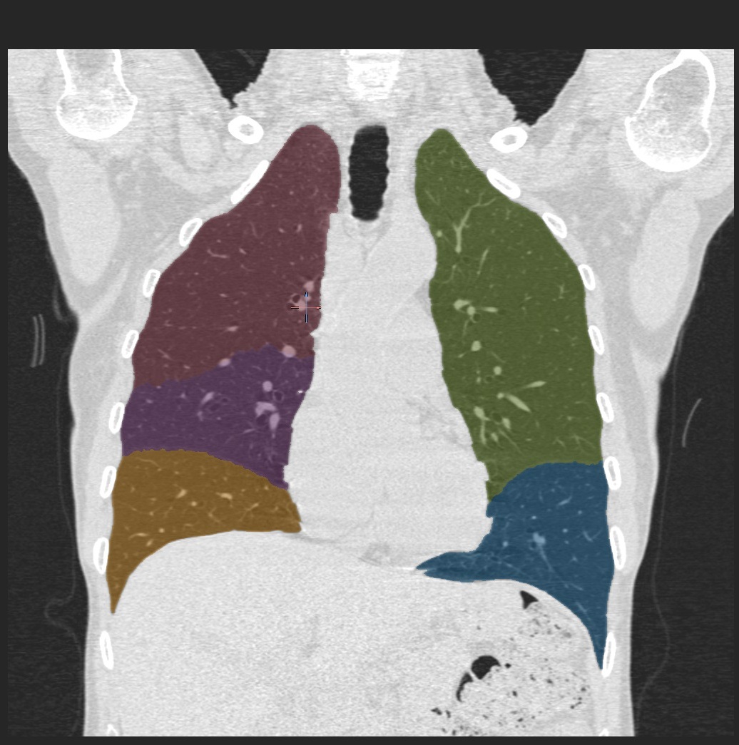 CT chest with colours